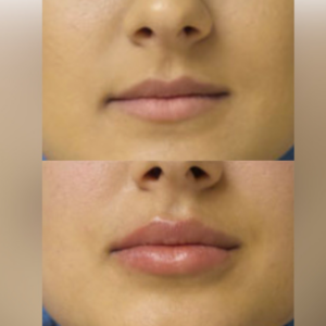 Filler before and after Wake Up Beautiful Spa