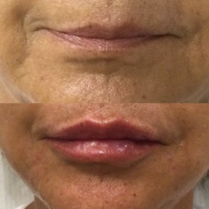 Wake Up Beautiful Spa before and After Aesthetic Results
