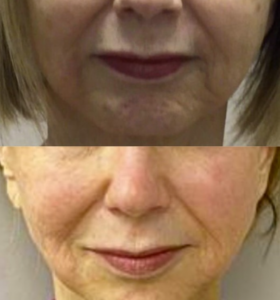 Wake Up Beautiful Spa before and After Aesthetic Results