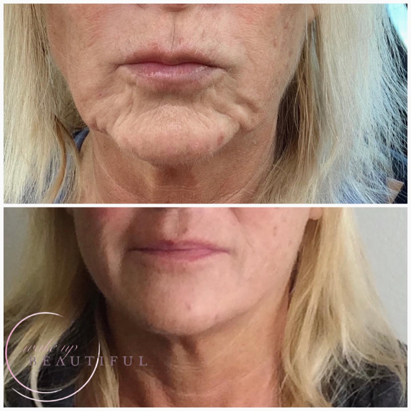 before-after-dermal-filler-4