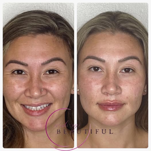 before-after-dermal-filler
