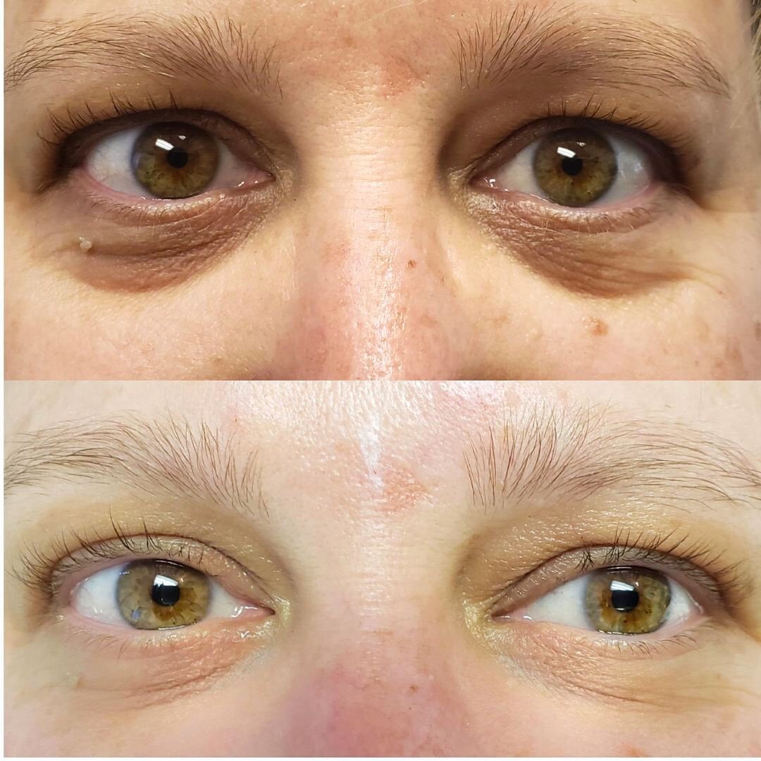 dermal-filler-under-eye
