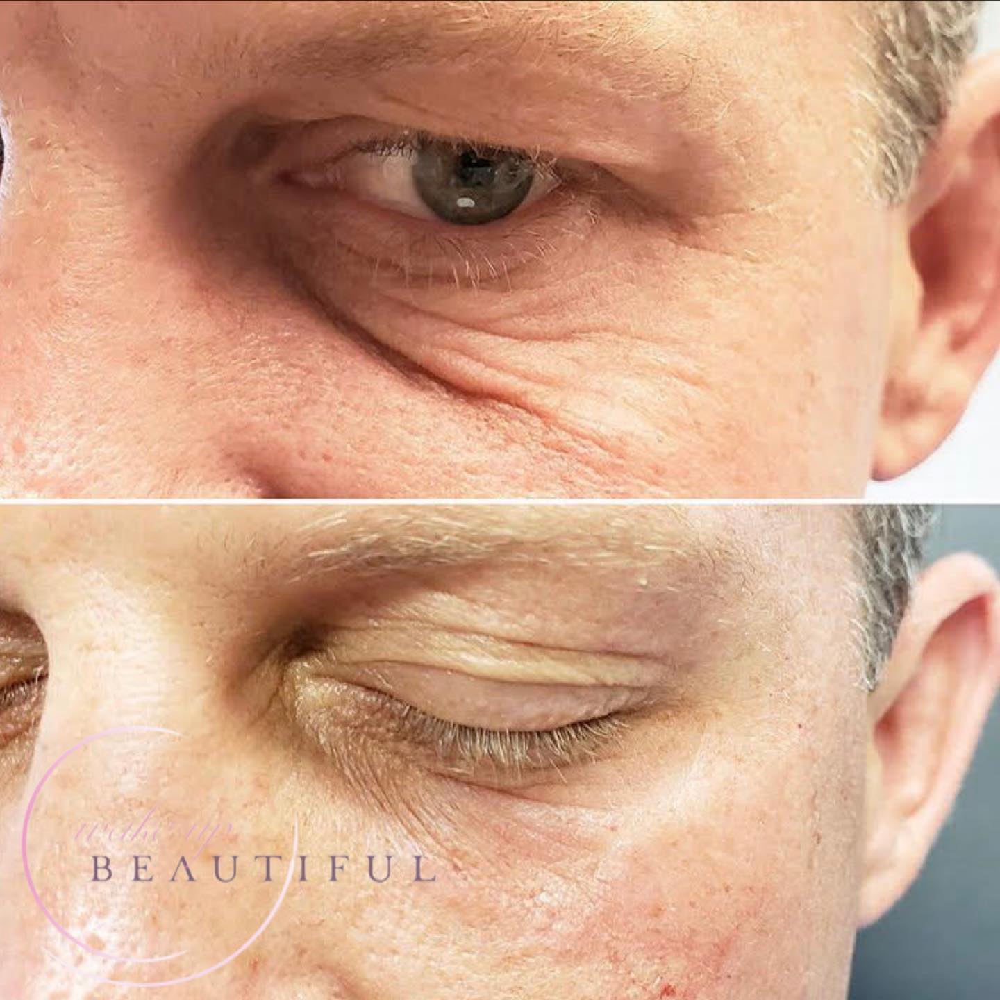 dermal-filler-undereye