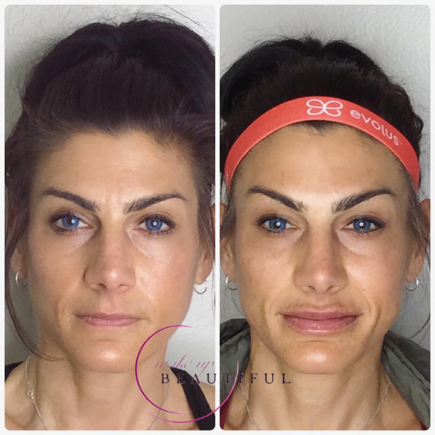 dermal-fillers
