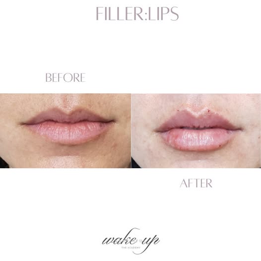 lip-filler