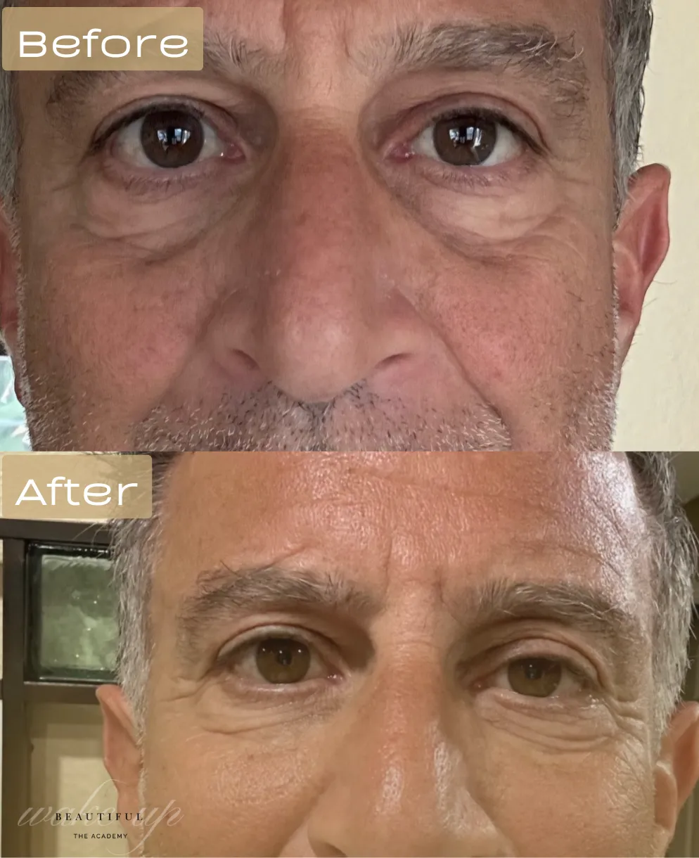 Befora and after of undereye filler