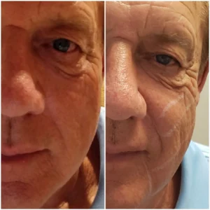 Before and after PDO Threads