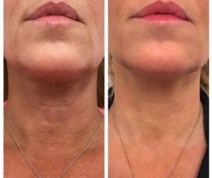 Wake Up Beautiful Spa before and after aesthetic results