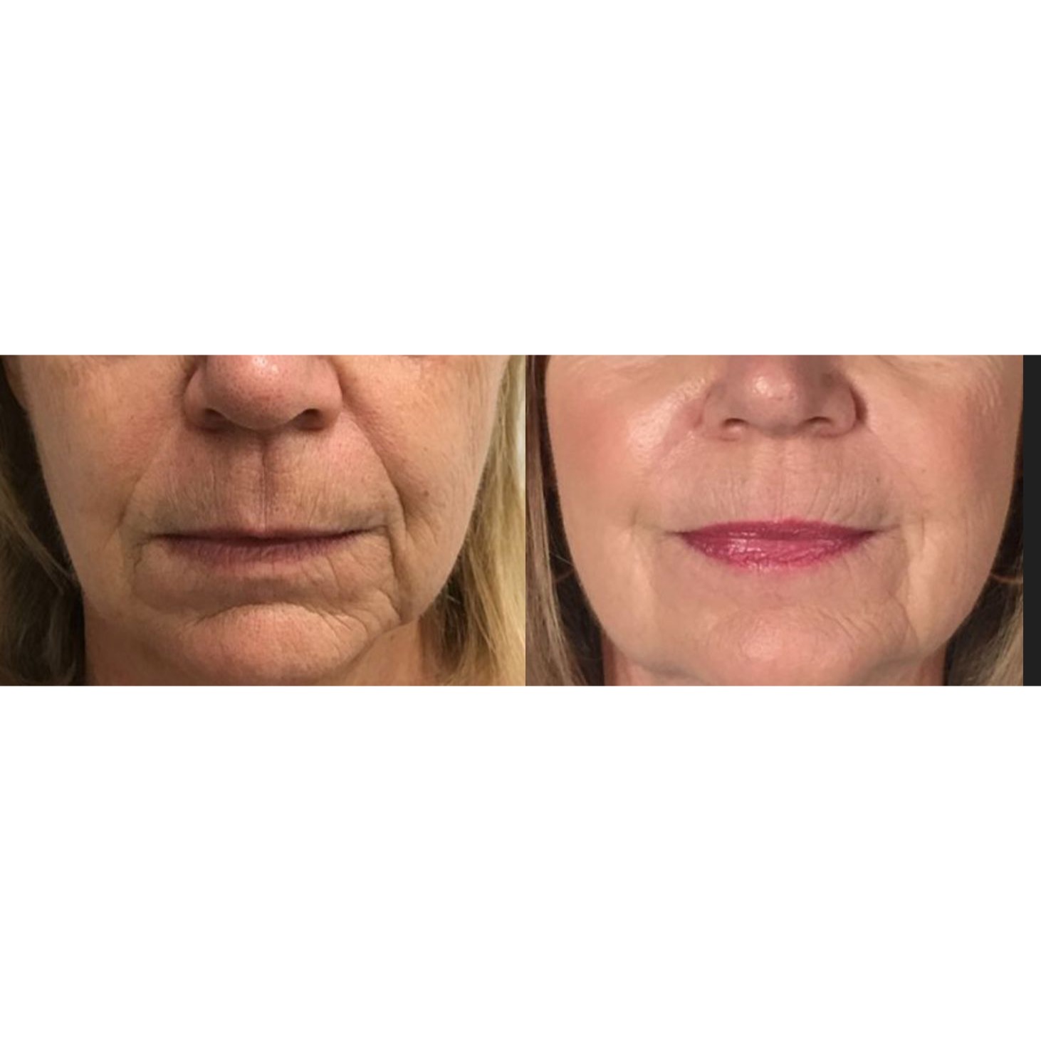 Lip blushing before and after: faded lips brightened with a natural pink permanent tint
